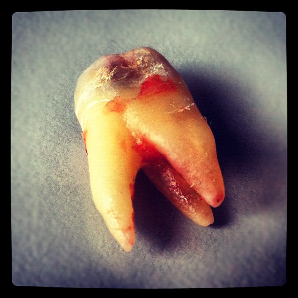 A nice present from me to the Tooth Fairy...! #tooth#teeth#pullingteeth#molar#ca...
